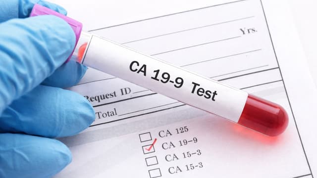 Xét nghiệm CA 19-9 ung thư tụy có ý nghĩa và giá trị như thế nào?
