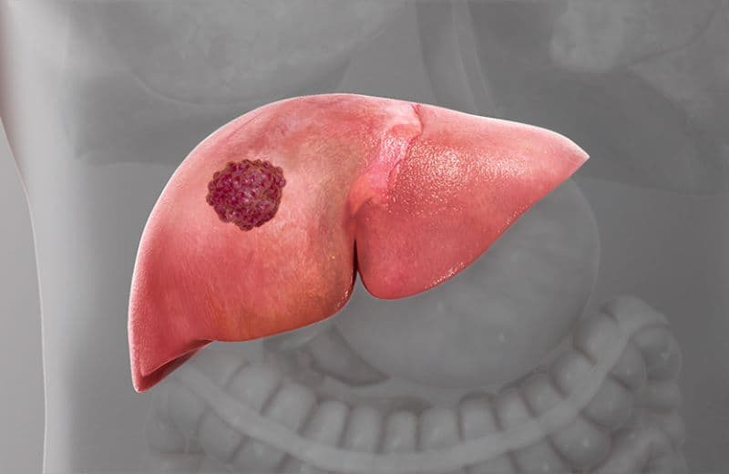 ung thư gan có gen di truyền không