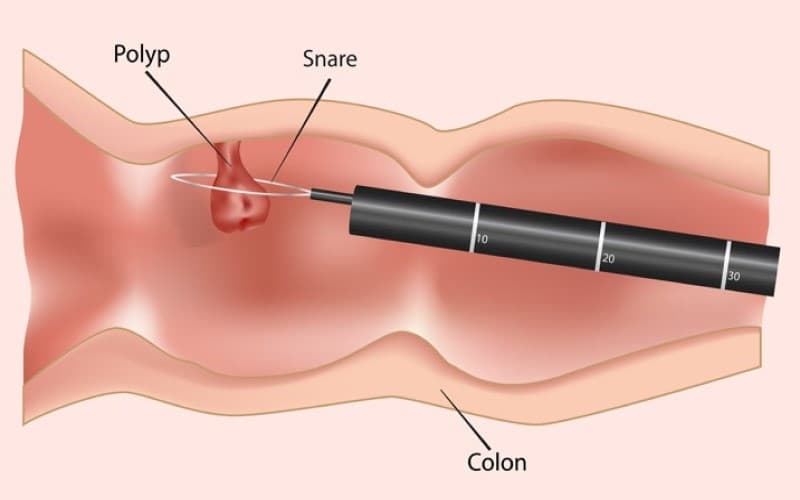 u đại tràng có lành tính không