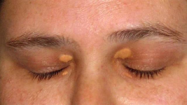 Cách trị u mỡ vàng xung quanh mắt