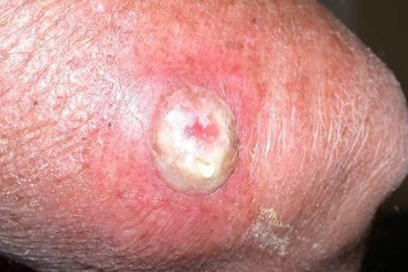 vết thương bị áp xe