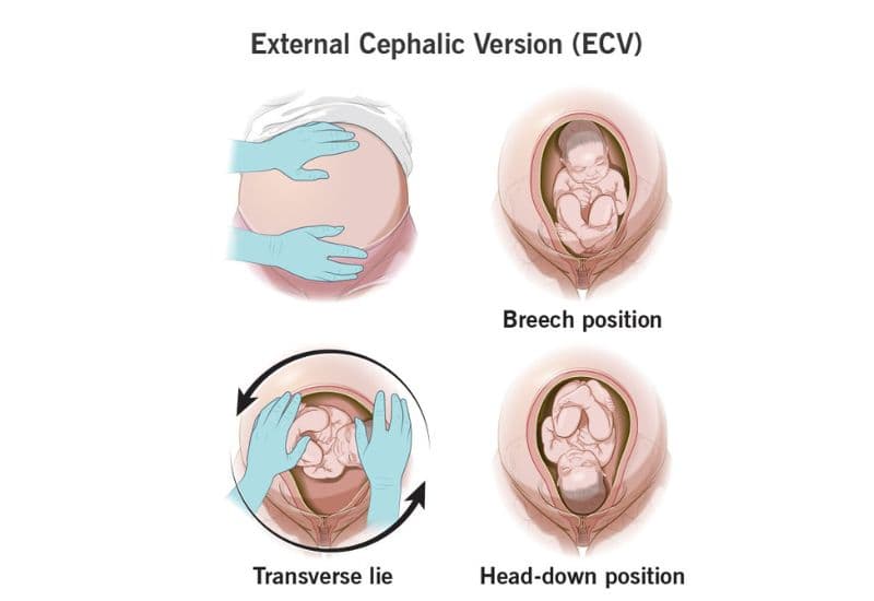 cách xoay ngôi thai ngược
