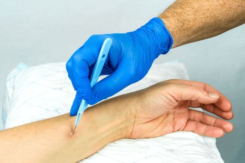 vết thương bị áp xe