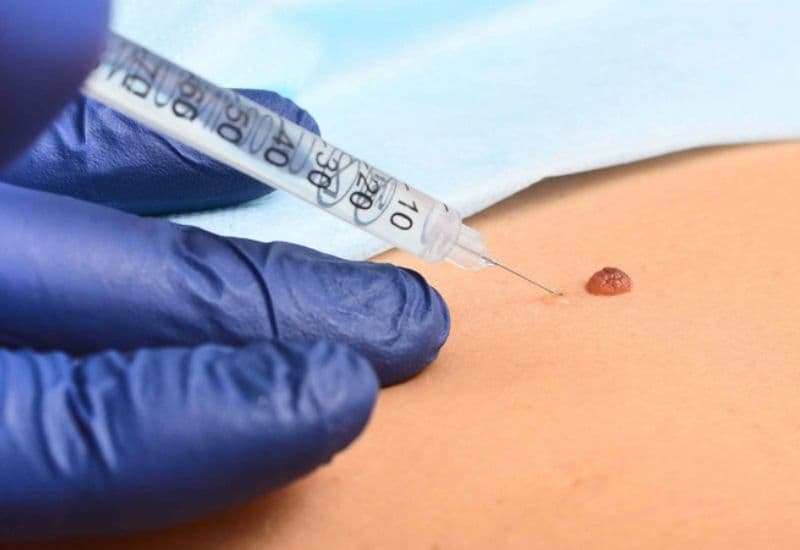 cắt da thừa hậu môn bao lâu thì lành