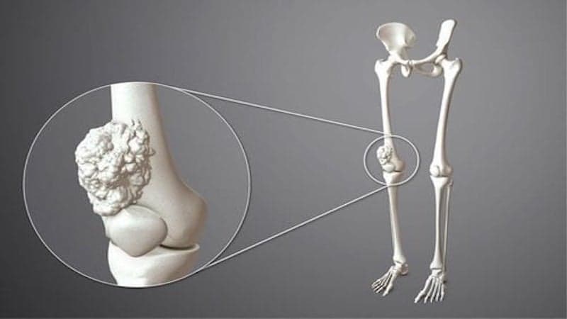 quy trình kỹ thuật cắt u xương sụn lành tính