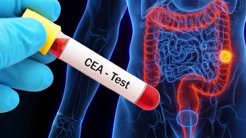 CEA chỉ dấu ung thư đại trực tràng