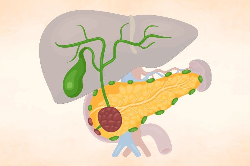 ca 19 9 ung thư tụy