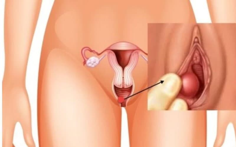 áp xe viêm tuyến bartholin có tự khỏi