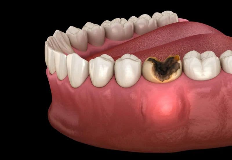 chữa tủy răng số 6 mất bao lâu