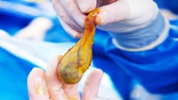 Đa polyp túi mật là gì? Có cần mổ không?