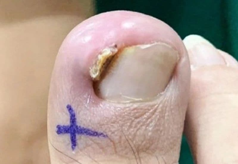 dấu hiệu móng chân mọc ngược