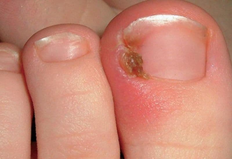 dấu hiệu móng chân mọc ngược