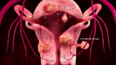 Các dấu hiệu u xơ tử cung lành tính