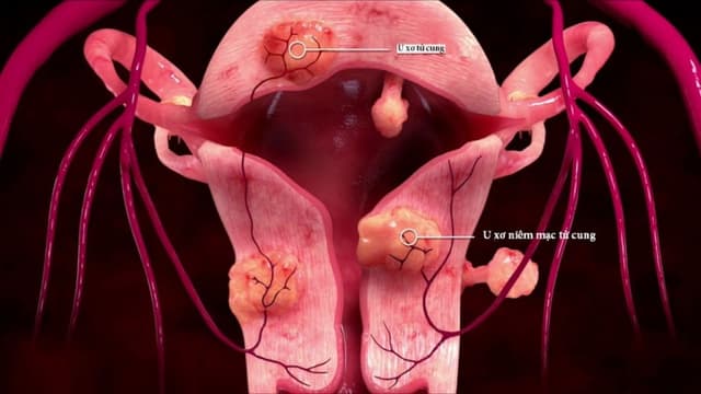 Các dấu hiệu u xơ tử cung lành tính