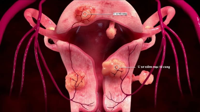 Các dấu hiệu u xơ tử cung lành tính