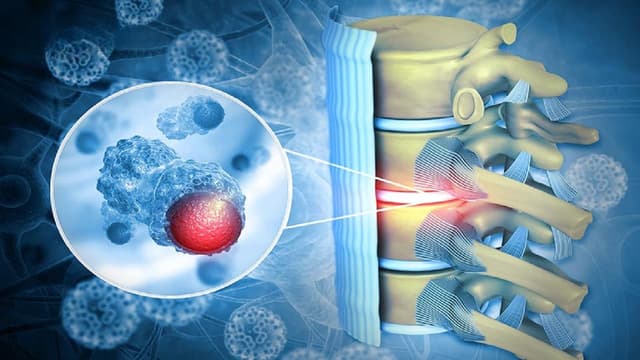 Dấu hiệu u xương lành tính