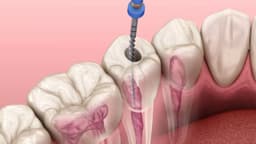 Diệt tủy răng mất bao lâu? Vẫn đau thì phải làm gì?