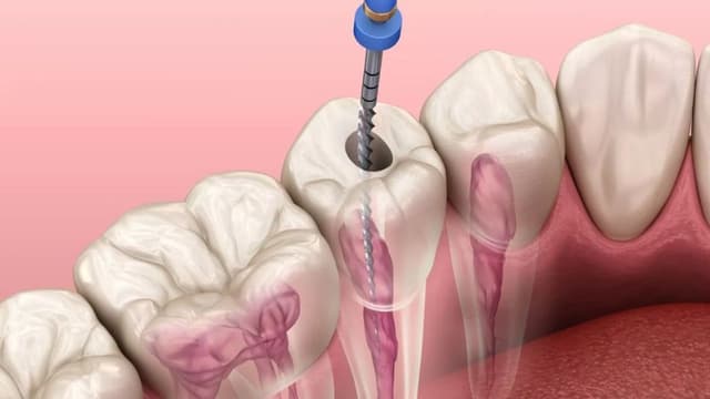 Diệt tủy răng mất bao lâu? Vẫn đau thì phải làm gì?