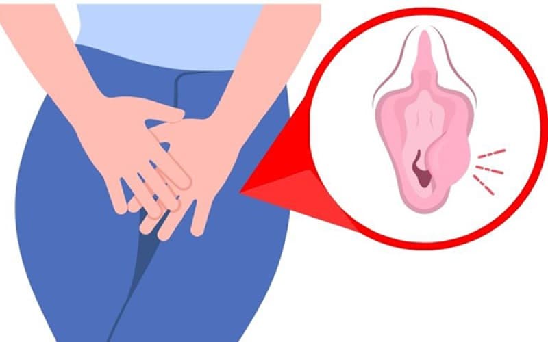 áp xe viêm tuyến bartholin có tự khỏi