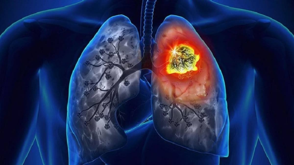 Đột biến del19 trên gen EGFR có gây ung thư phổi?