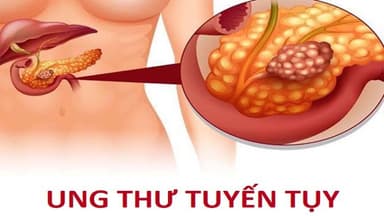 Đột biến gen BRCA2 có liên quan đến nguy cơ mắc ung thư tuyến tụy tăng gấp 3 đến 10 lần