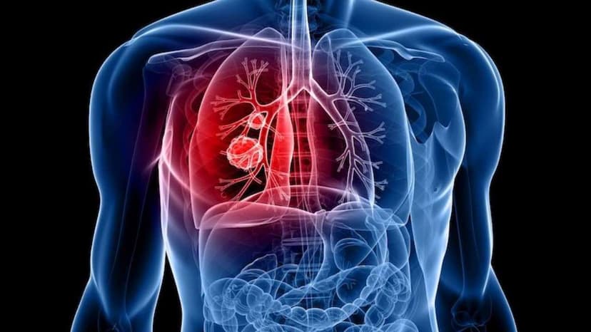 Đột biến gen KRAS trong ung thư phổi