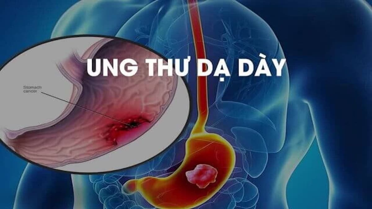 Đột biến gen trong ung thư dạ dày