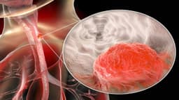 Đột biến gen trong ung thư thực quản