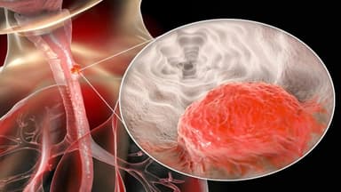 Đột biến gen trong ung thư thực quản