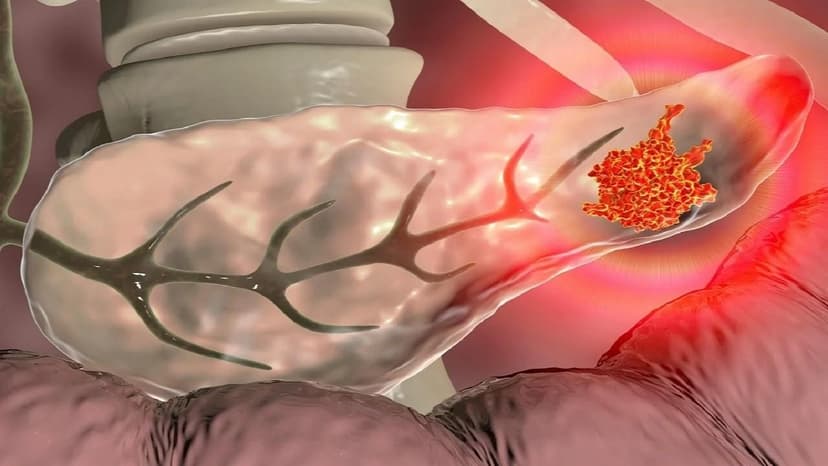 Đột biến gen trong ung thư tuyến tụy