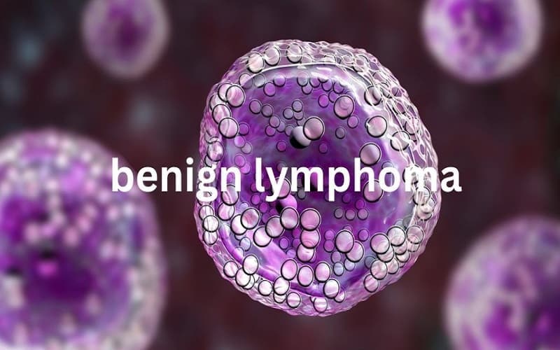 u lành hạch lympho