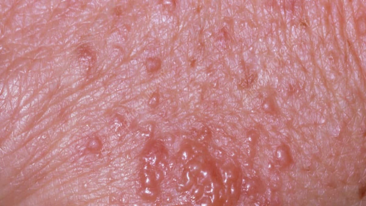 Hình ảnh dị ứng thuốc kháng sinh tại từng bộ phận cơ thể