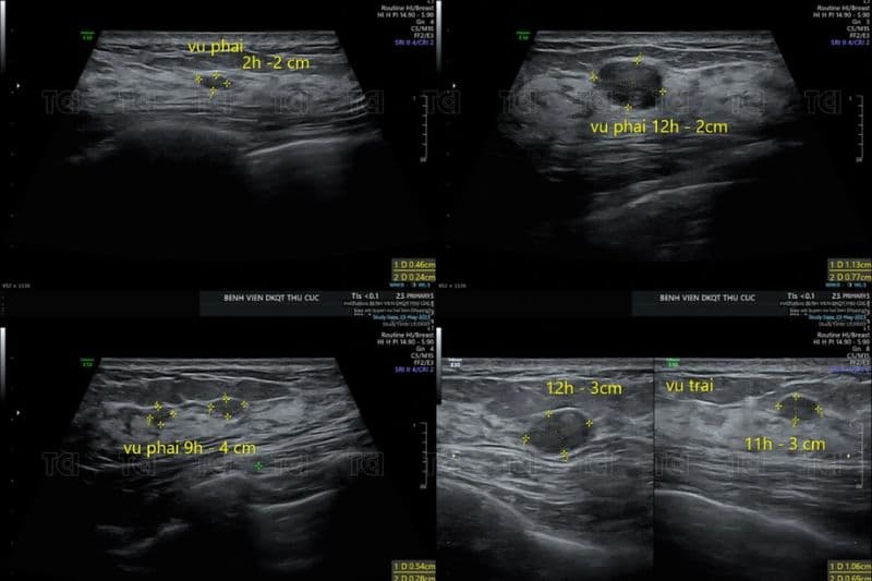 siêu âm vú phát hiện bệnh gì