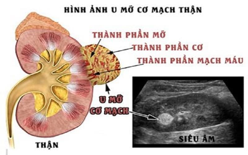 u cơ mỡ thận
