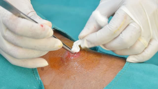 Hút dịch áp xe vú có đau không?