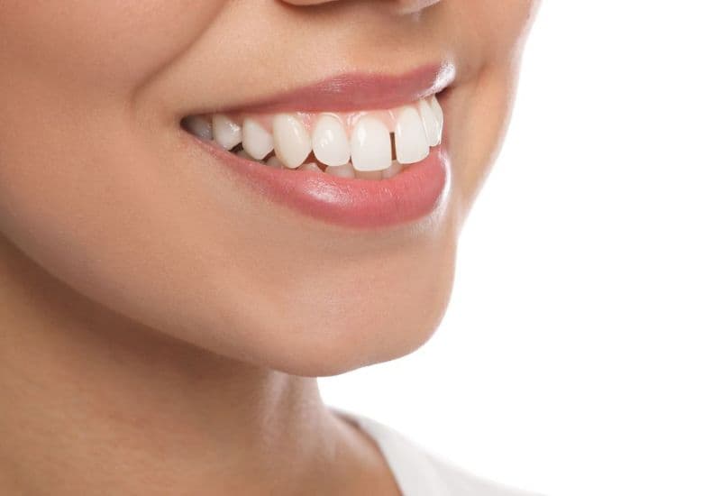 kéo cụm 4 răng cửa mất bao lâu