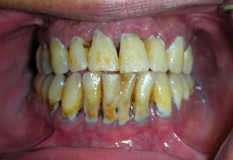 kéo cụm 4 răng cửa mất bao lâu