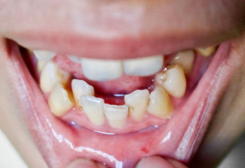 kéo răng 3 vào răng 5 mất bao lâu