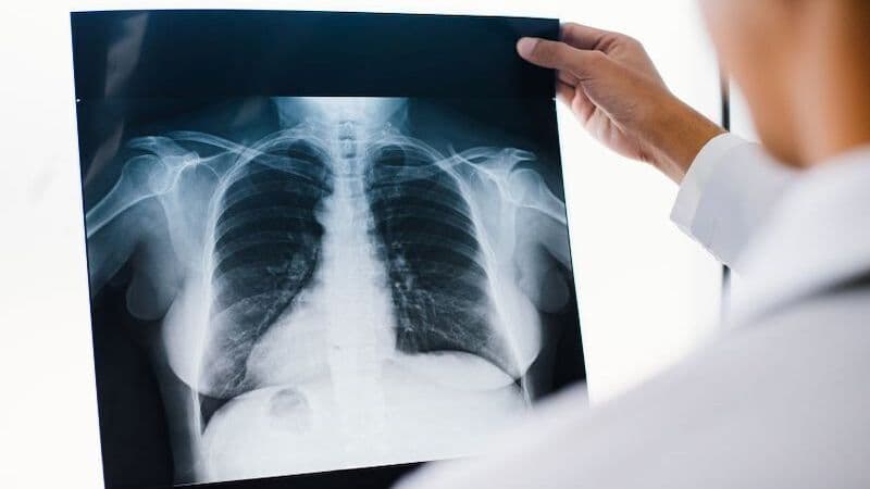 dấu hiệu u phổi lành tính