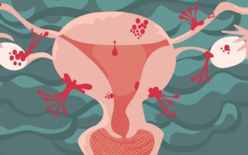 bệnh cơ tuyến tử cung có nguy hiểm không