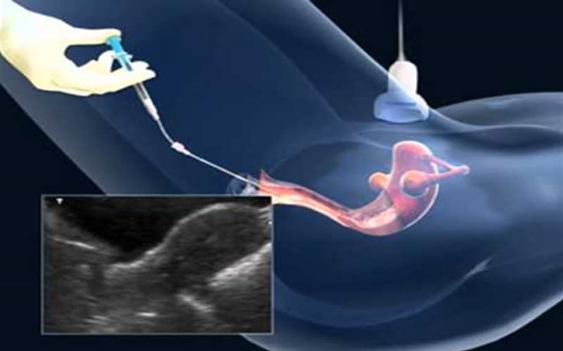 tử cung 2 sừng có làm ivf được không