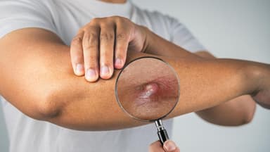 Làm sao để hết áp xe có mủ? Lưu ý khi điều trị và chăm sóc