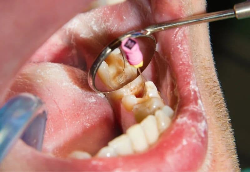 lấy tủy răng số 7 có đau không