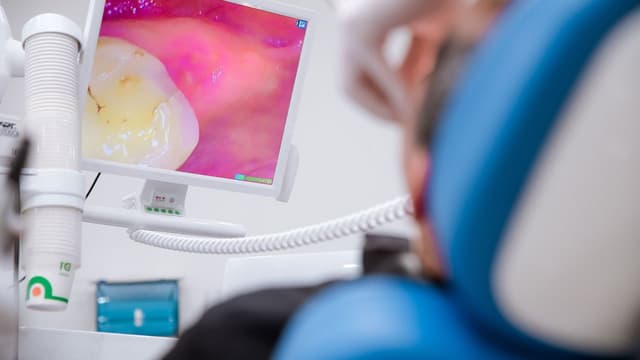 Mất 1 răng hàm trên có sao không?