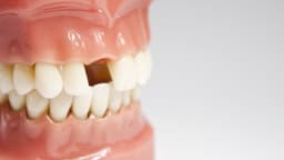 Mất 2 răng cửa có niềng được không?