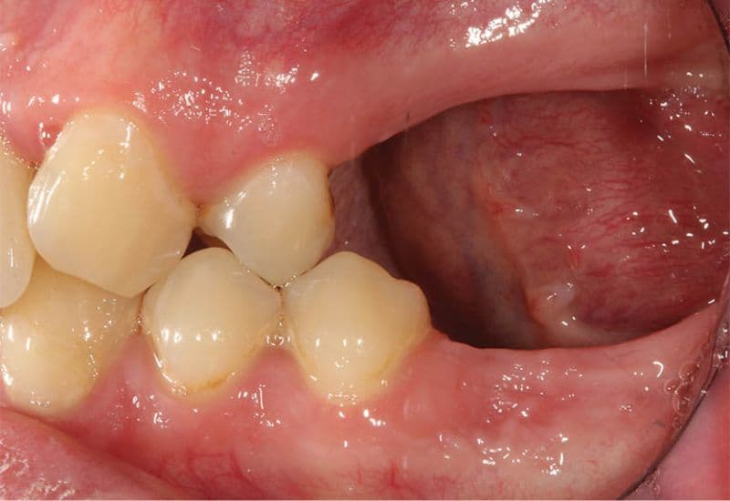 mất răng bao lâu thì tiêu xương