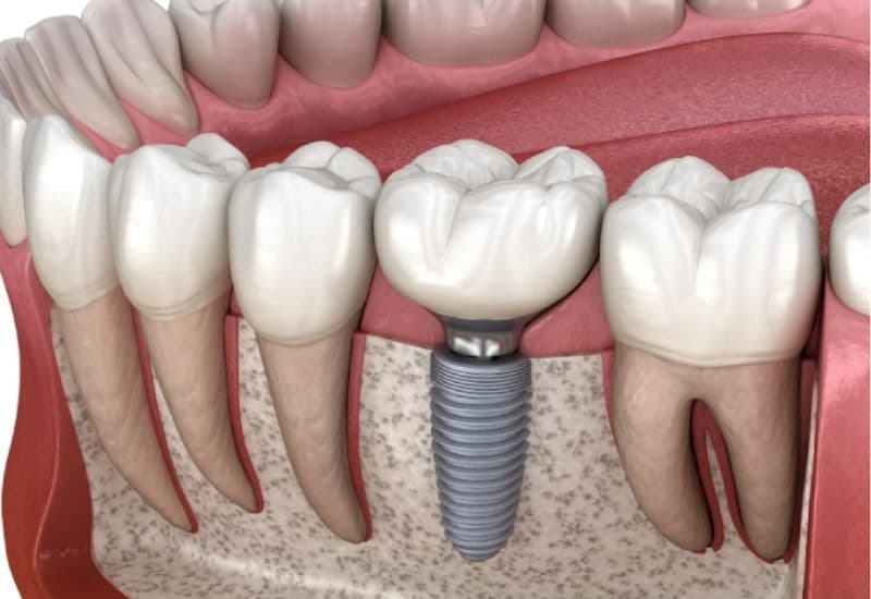 mất răng bao lâu thì tiêu xương