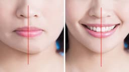 Mất răng hàm có bị lệch mặt không?