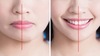 Mất răng hàm có bị lệch mặt không?