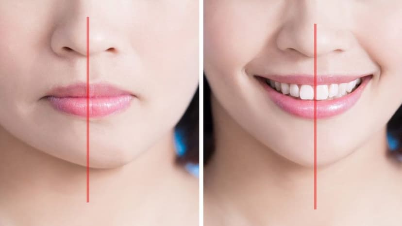 Mất răng hàm có bị lệch mặt không?